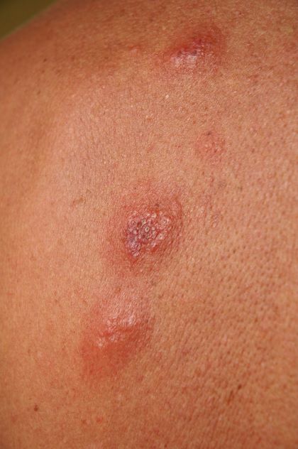 flea bite allergic reaction